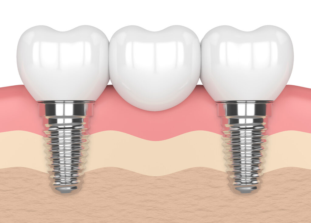 implants in gums