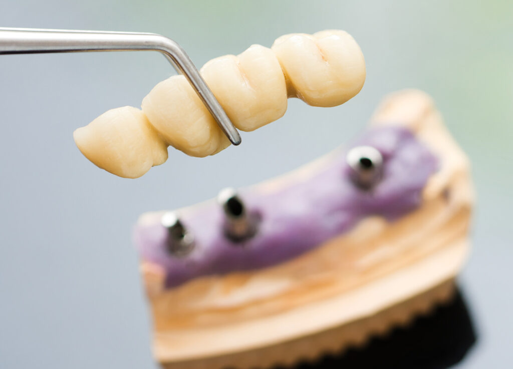 dental bridge on implants