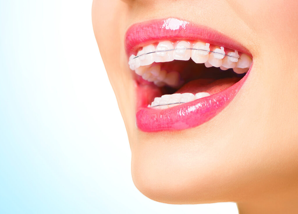 woman with ceramic braces