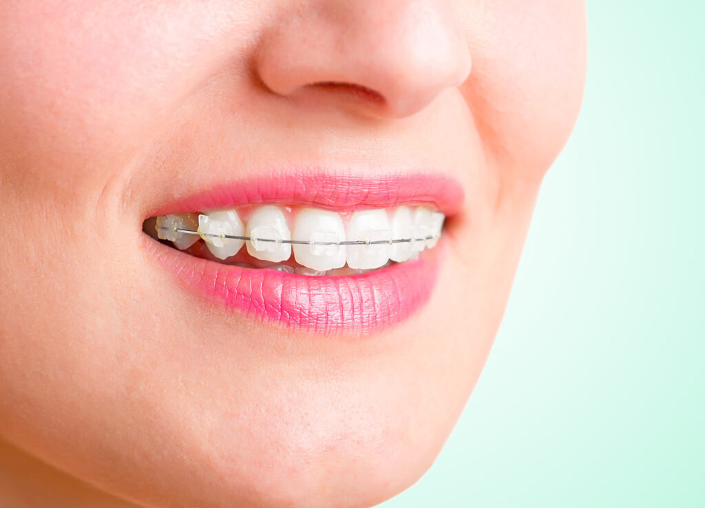  close up of clear braces