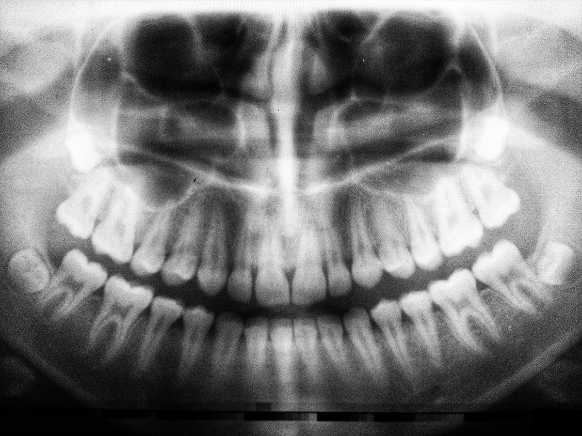 tooth x-ray