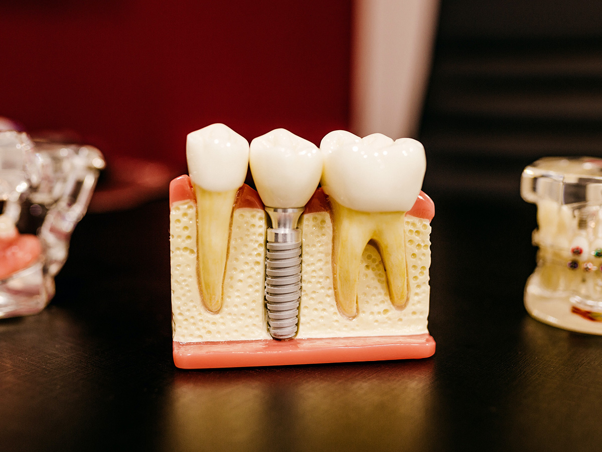 root canal diagram