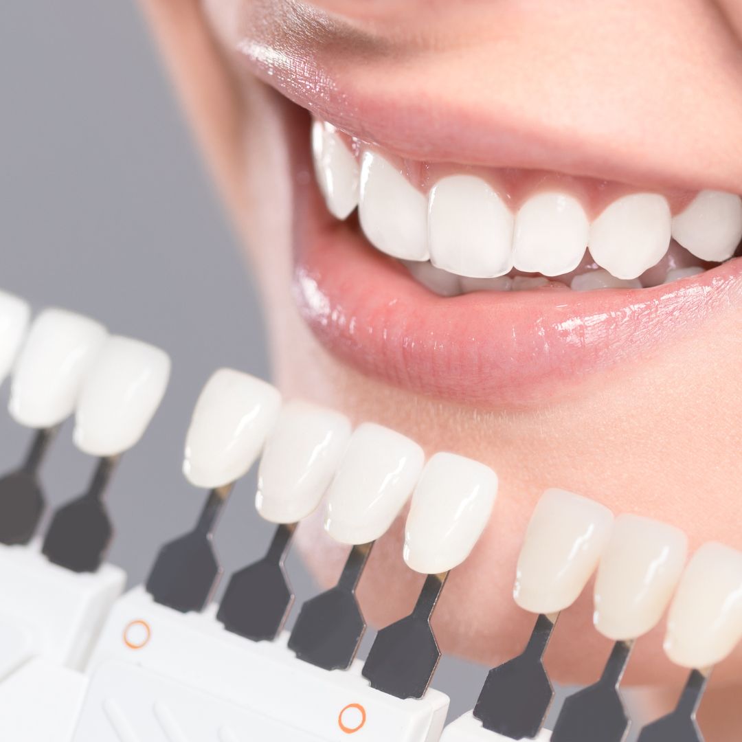 Veneers
