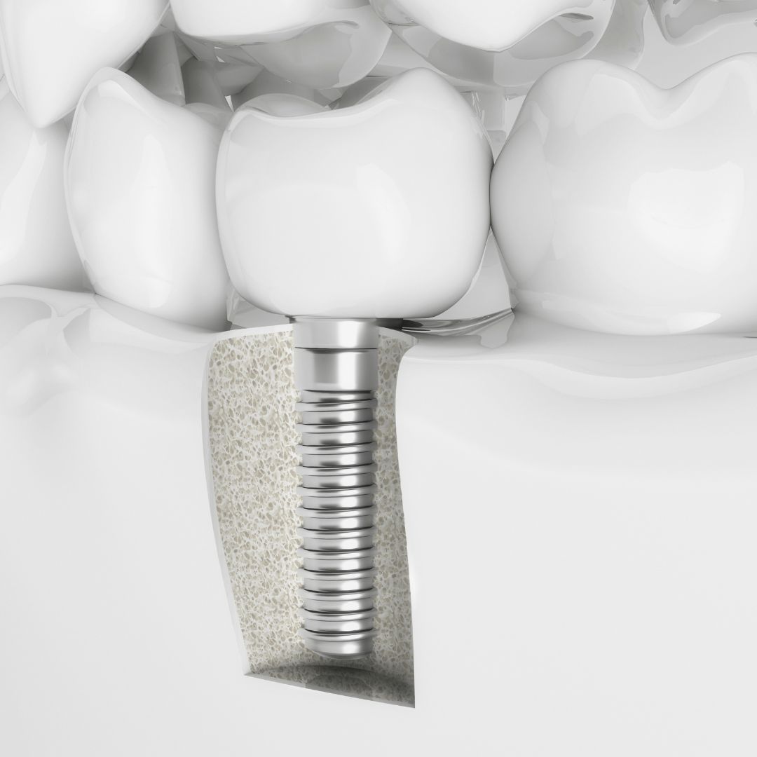 Implants