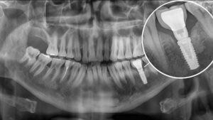 X-ray of dental implant