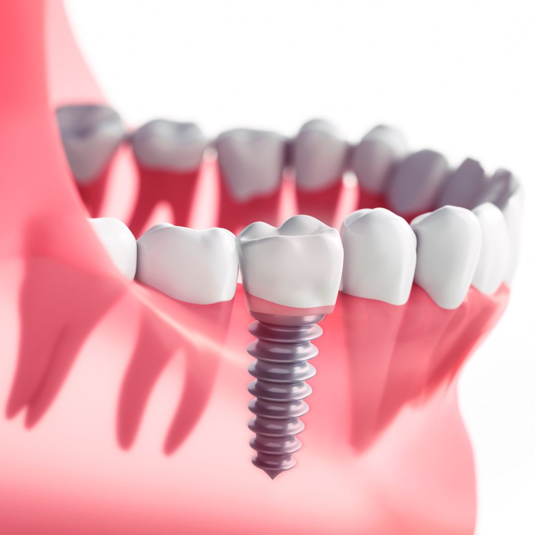 dental implant