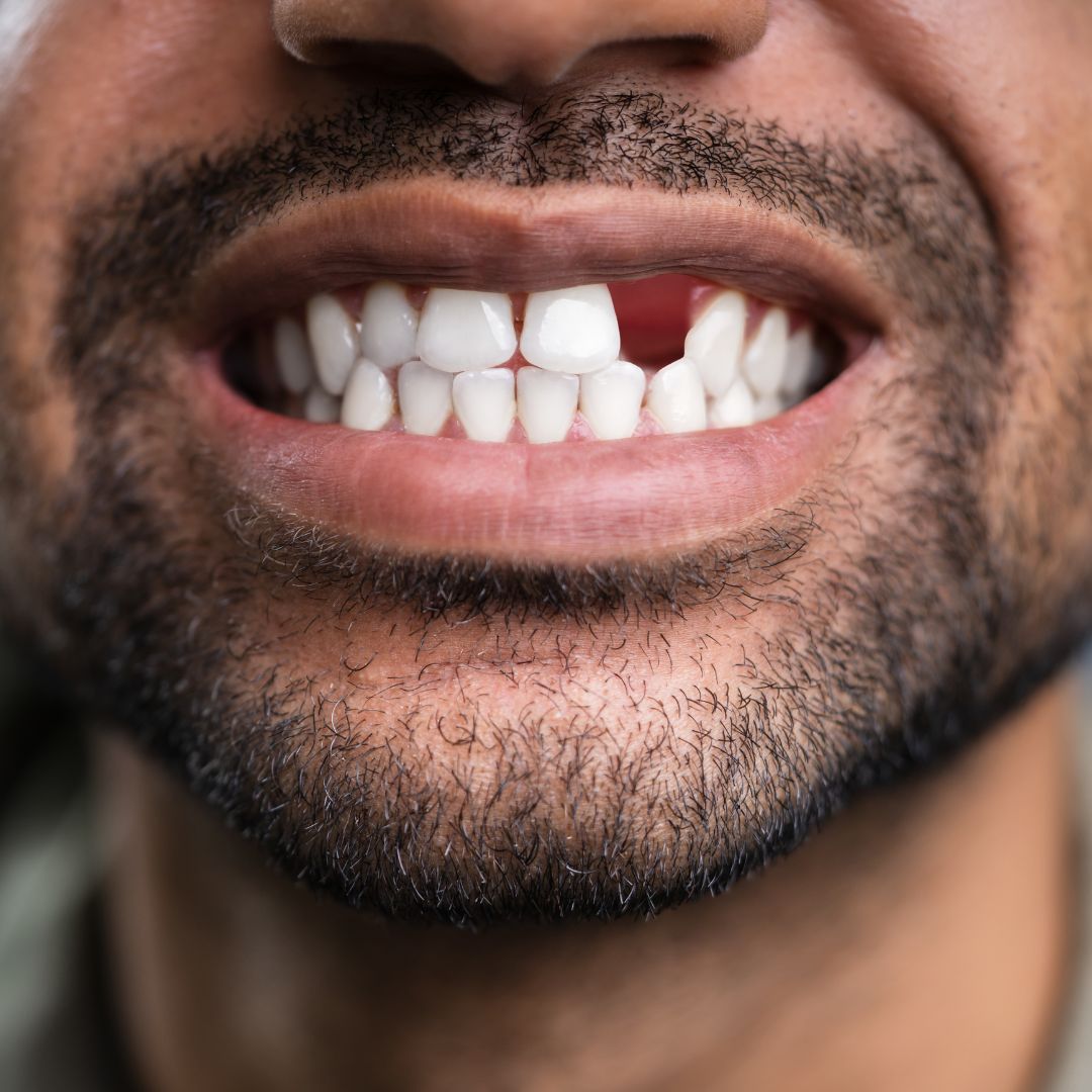 man missing a tooth