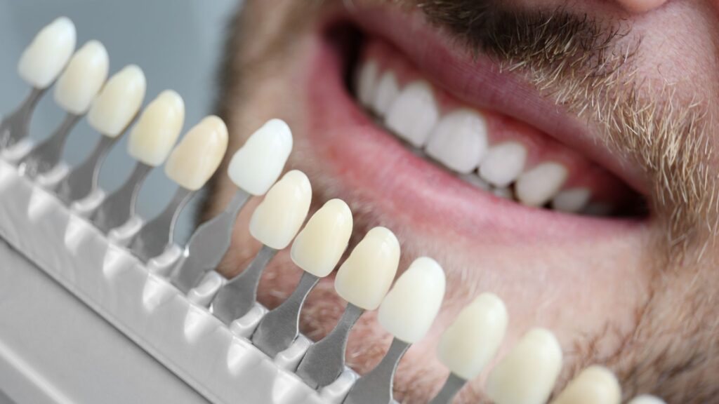 veneersheader