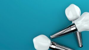 image of dental implants