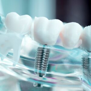 image of a dental implant