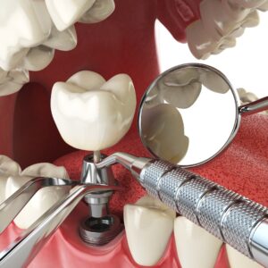image of a dental implant