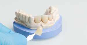 Veneers