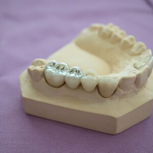 a mouth mold with metal fillings