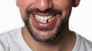 Man smiling with a missing tooth