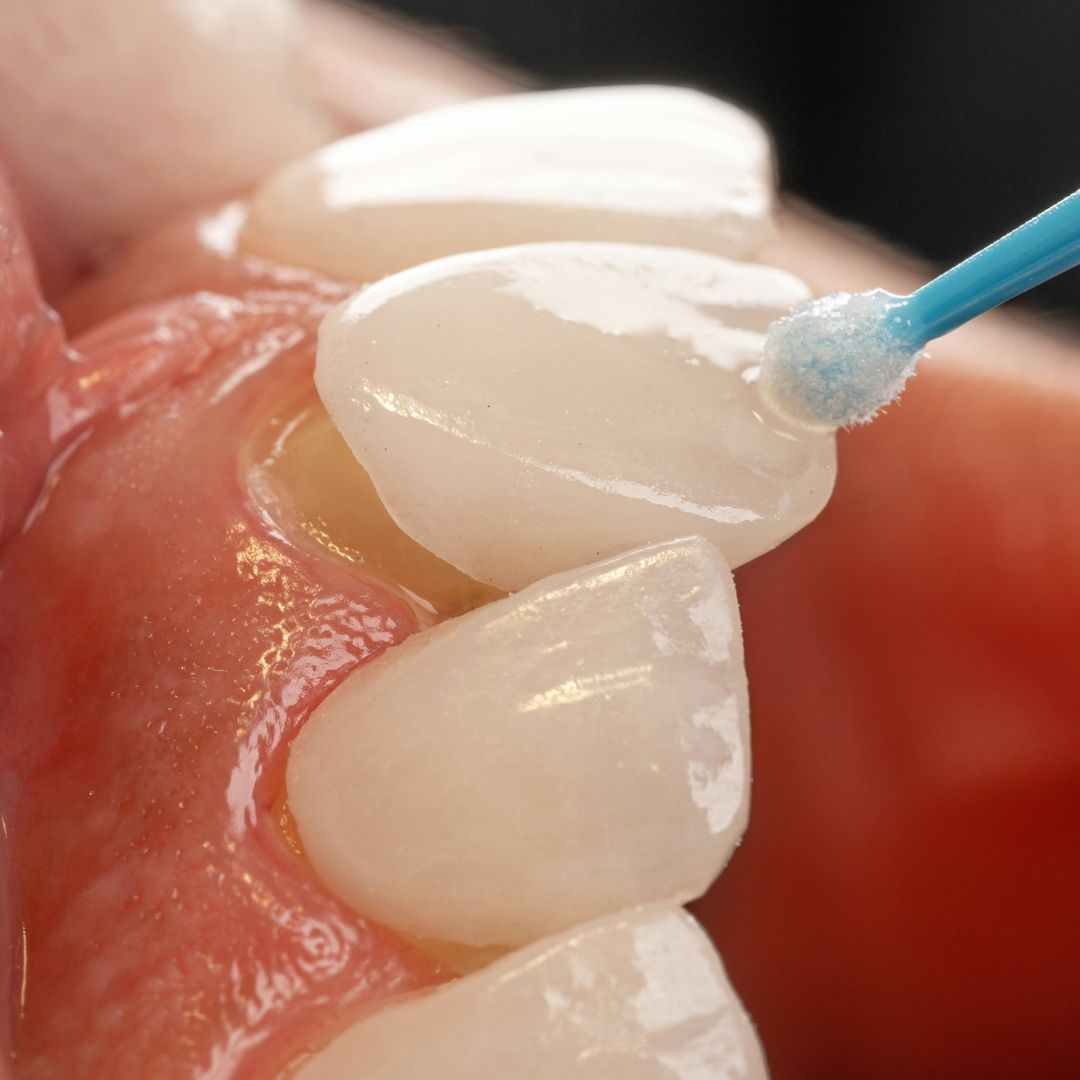 a close-up of veneers being placed