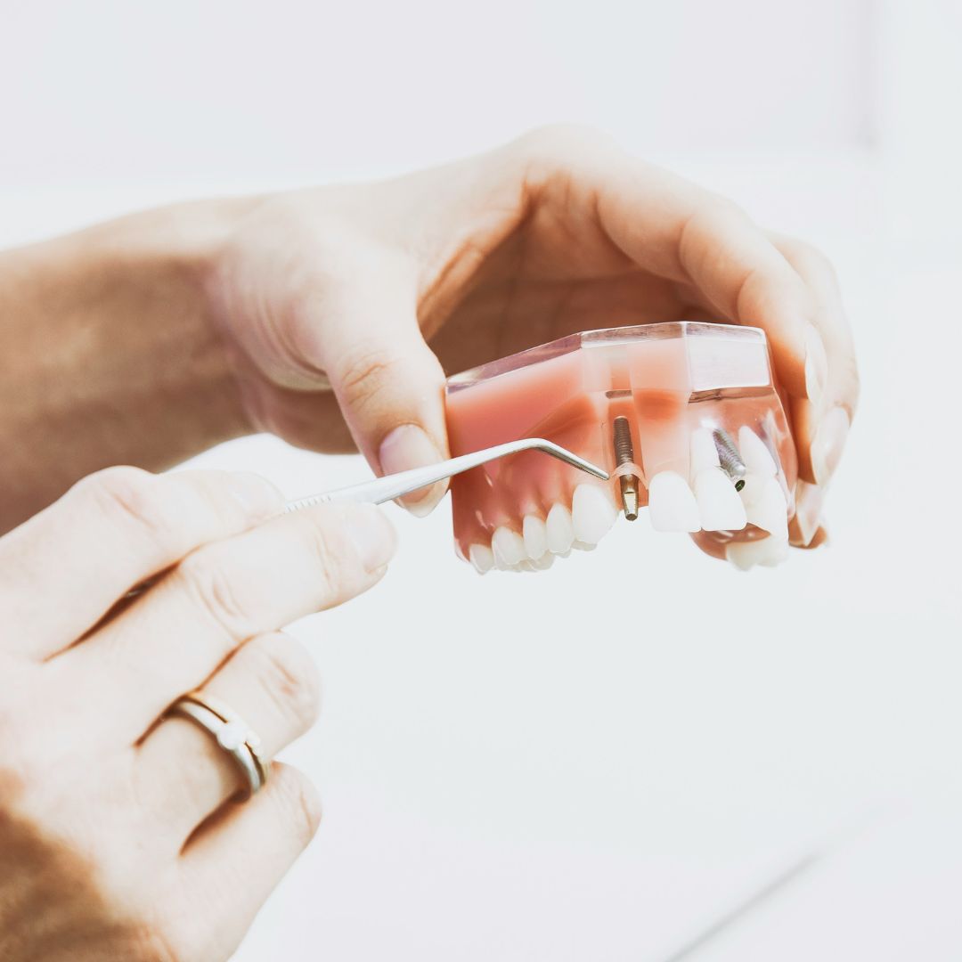 a dental implant: