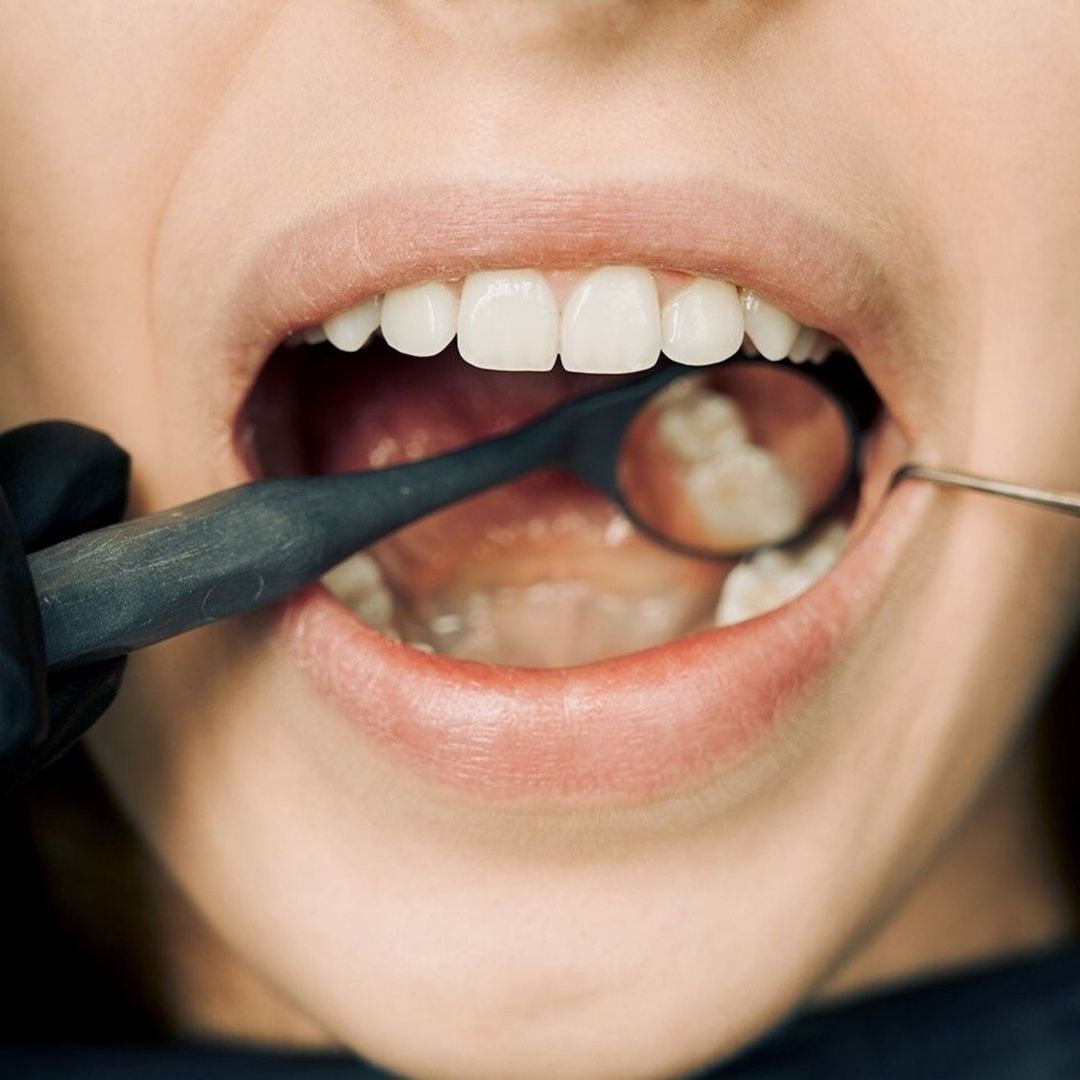 Shifitng teeth in a patient's mouth.