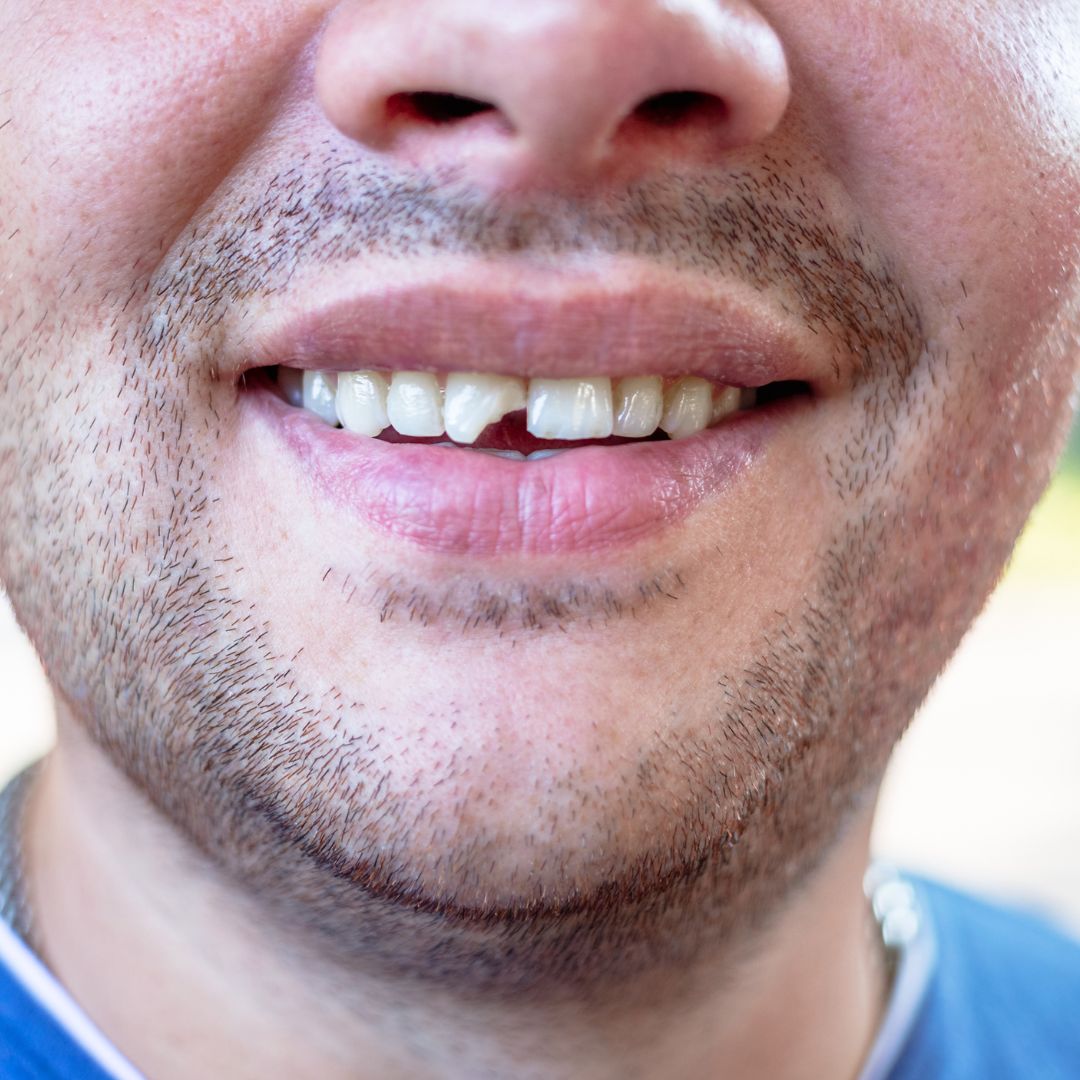 Chipped tooth.